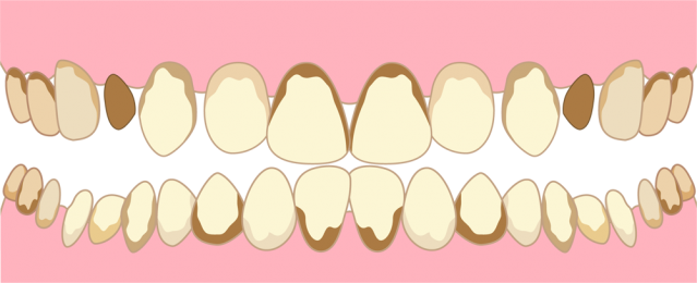 虫歯がひどい歯 Csai Png 無料イラスト素材 素材ラボ
